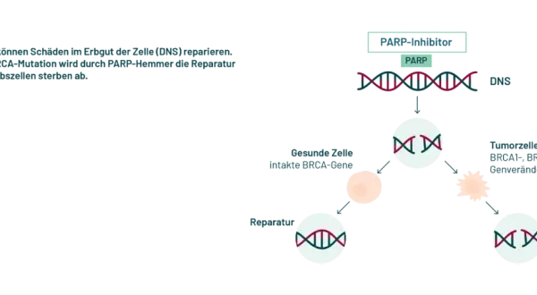 PARP-Inhibitoren blockieren die Reparatur von DNS-Schäden in Krebszellen mit BRCA-Mutation, was zu deren Absterben führt. Erste parp-inhibitor erfahrungsberichte zeigen Erfolge.