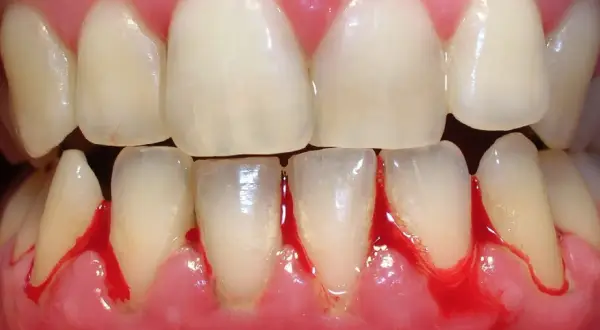 Encías inflamadas y sangrantes, un claro signo de gingivitis. La salud bucal es importante.