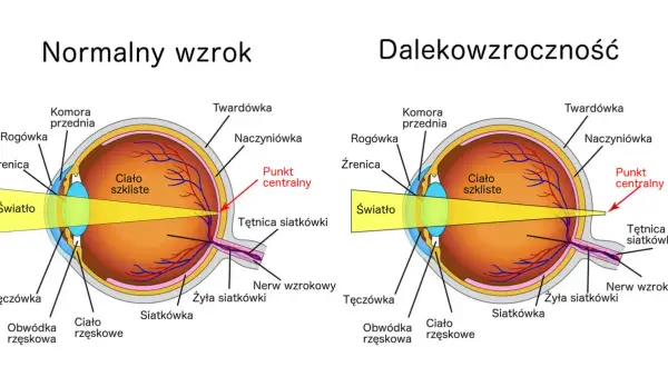 Na czym polega dalekowzroczność? Obraz pokazuje, że światło skupia się za siatkówką, a nie na niej, co powoduje nieostre widzenie.