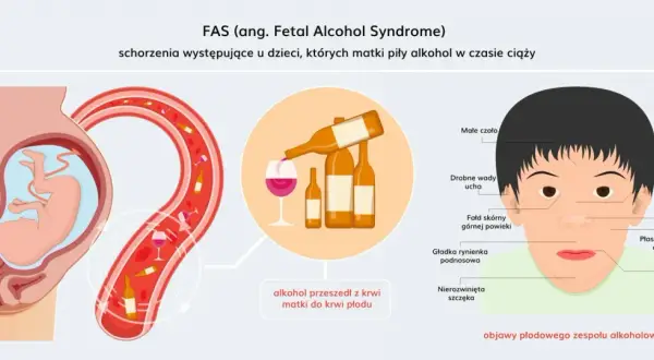 Ilustracja pokazuje, jak alkohol przechodzi z krwi matki do płodu, powodując alkoholowy zespół płodowy. Widoczne są charakterystyczne cechy twarzy dziecka, takie jak małe czoło, krótki nos i cienka górna warga.