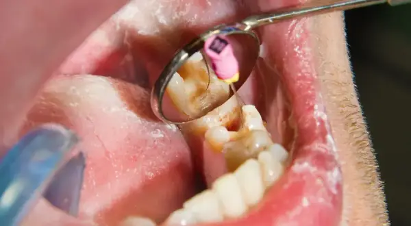 Widok jamy ustnej z lustrem dentystycznym, ukazującym ząb z widocznym stanem zapalnym, sugerującym nieleczony ropień zęba.