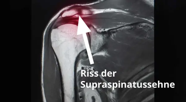 MRT-Aufnahme zeigt Riss der Supraspinatussehne. Erfahrungen mit Schulter-OP nach Sehnenriss.