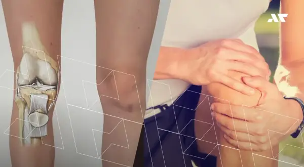 Anatomia kolana po lewej, a po prawej osoba trzymająca się za bolące kolano.