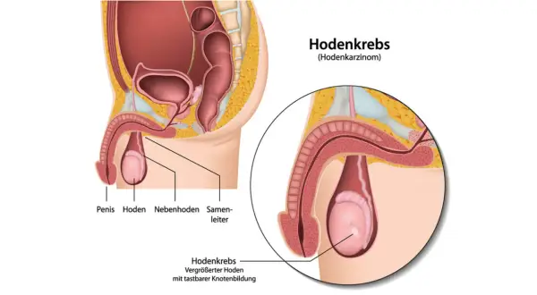 Anatomische Darstellung des männlichen Beckens mit Fokus auf den Hoden. Ein vergrößerter Hoden mit tastbarer Knotenbildung zeigt Hodenkrebs Symptome.