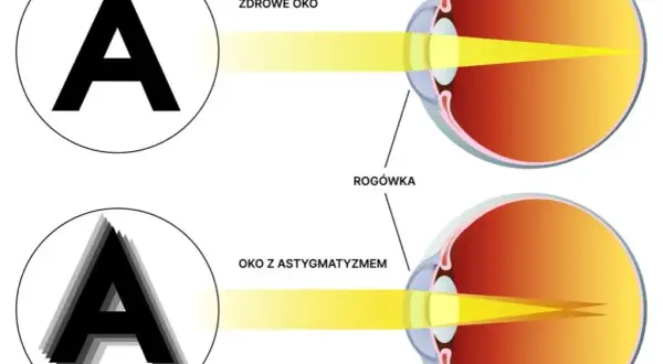 Jak widzi astygmatyk? Symulacje, objawy i korekcja