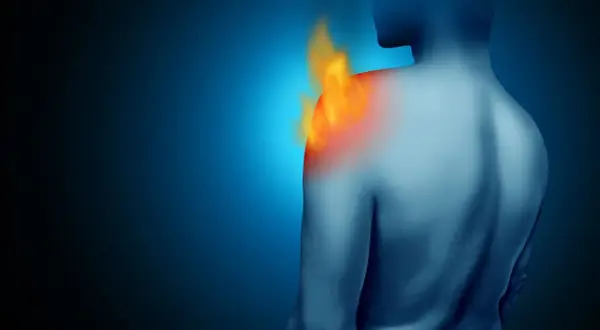 Schulteransicht mit Flammen, die den entzündeten Schleimbeutel in der Schulter symbolisieren.