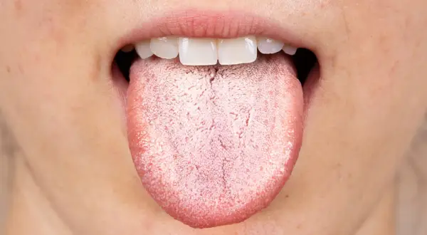 Lingua impaniata, con papille evidenti e una patina biancastra che ne altera la superficie.