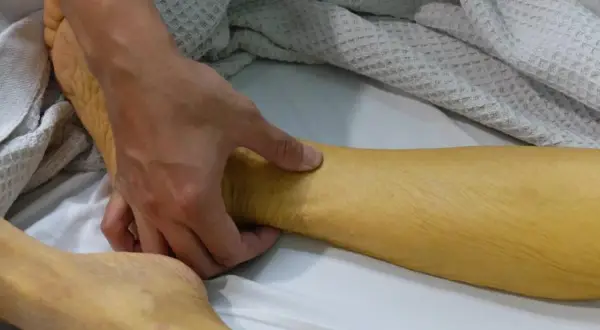 Dłoń bada zażółconą skórę nogi, wskazując na żółtaczkę.