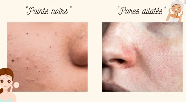 Comparaison de peau : points noirs et pores dilatés. Découvrez comment resserrer les pores pour une peau plus lisse.