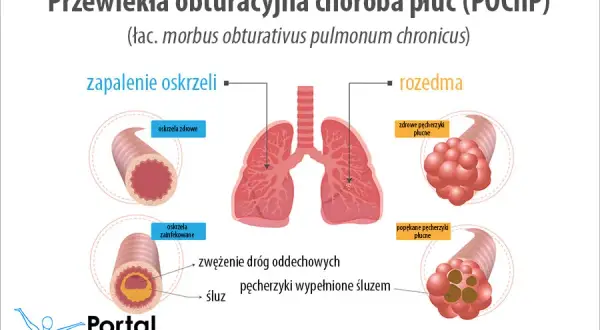 POChP a klimat: Gdzie szukać ulgi i jak oddychać lepiej?