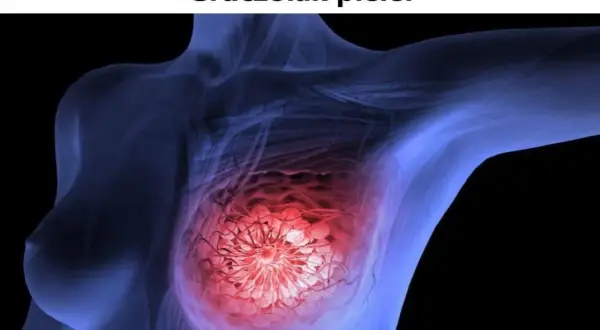Anatomical illustration of a breast with a highlighted area indicating a tumor. Różne rodzaje guzów w piersiach mogą wymagać odmiennych metod leczenia.