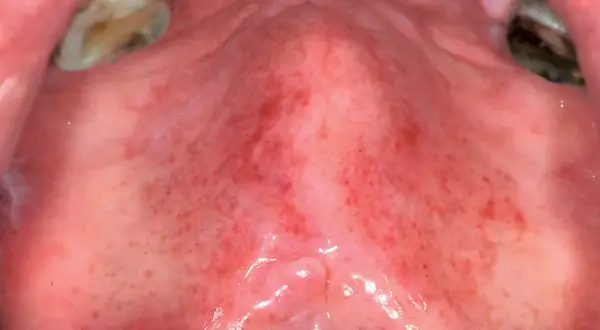 Palato con aree arrossate e puntini rossi, indicativi di una lesione palato. Si notano anche denti e gengive.