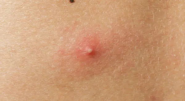 Jak pozbyć się pryszczy na plecach? Sprawdzone metody i porady