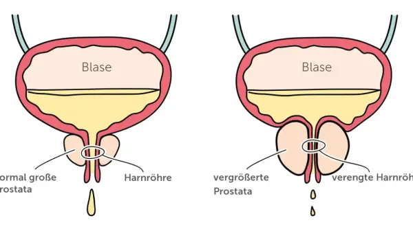 Vergleich von normaler und vergrößerter Prostata. Die vergrößerte Prostata kann zu verengter Harnröhre und damit zu Problemen beim Wasserlassen führen, ein mögliches Prostata Symptom.
