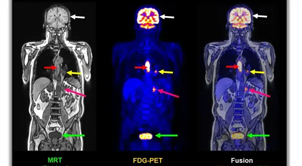 Ganzkörper-PET-CT-Bilder zeigen bösartige Herde. Pfeile markieren Auffälligkeiten in Gehirn, Brustkorb und Becken.