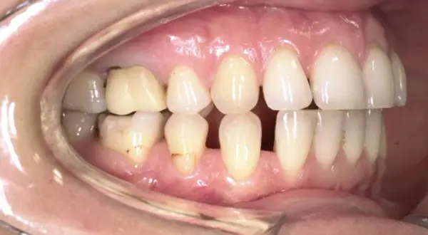 Denti con evidente overjet e overbite, alcuni incisivi superiori coprono quasi completamente quelli inferiori.