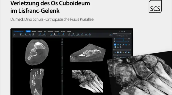 CT-Aufnahmen zeigen eine Verletzung des Os cuboideum im Lisfranc-Gelenk. Die Darstellung ermöglicht eine detaillierte Analyse der Knochenstruktur.