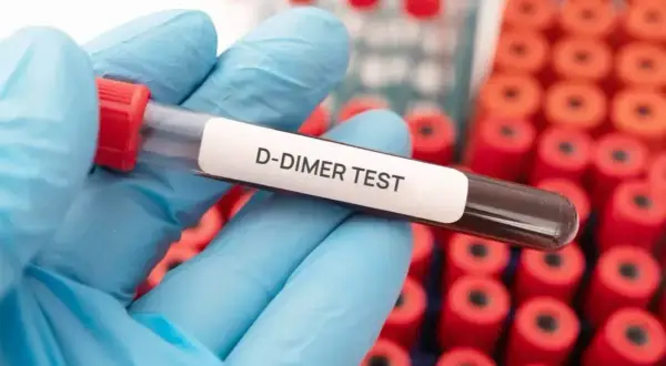 Ręka w niebieskiej rękawiczce trzyma probówkę z napisem "D-DIMER TEST". W tle widać rząd czerwonych probówek. Badanie d-dimery a stan zapalny.