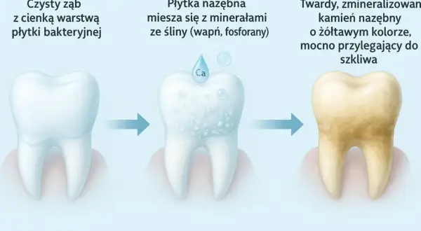 Jak wygląda kamień na zębach: od czystego zęba, przez płytkę nazębną mieszającą się z minerałami, aż do twardego, żółtawego kamienia mocno przylegającego do szkliwa.