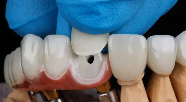 Dłoń w niebieskiej rękawiczce dopasowuje ceramiczną koronę zęba do modelu.