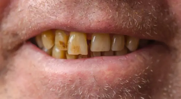 Primer plano de una boca con dientes amarillentos y manchas de esmalte.