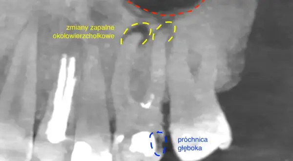 Obraz RTG z widocznymi zmianami zapalnymi okołowierzchołkowymi zęba, zapaleniem zatoki szczękowej i głęboką próchnicą.