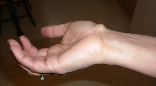 Polso con cisti sinoviale, in cerca di una pomata efficace per alleviare il disturbo.