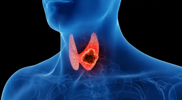 Anatomical illustration showing a human neck with a glowing red thyroid gland. A dark, irregular mass, representing rak brodawkowaty tarczycy, is visible within the gland.
