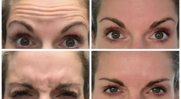 Vier close-ups van een voorhoofd met rimpels, die de effecten van botox tonen. Sommigen beweren dat botox slecht voor hersenen kan zijn.