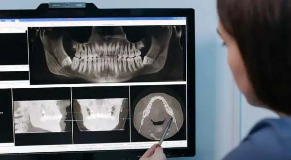 Dentysta analizuje zdjęcia RTG szczęki, planując powtórne leczenie kanałowe.