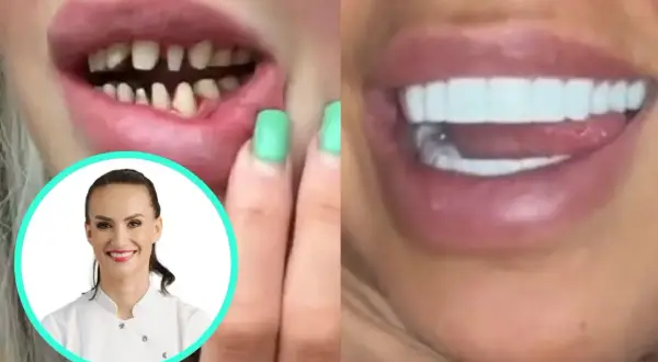 Przed i po: nieudane tureckie zęby, powikłania po zabiegu, a obok uśmiechnięta dentystka.