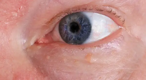 Nahaufnahme eines blauen Auges mit kleinen Bläschen am Lidrand, die auf **Herpes am Auge** hindeuten könnten.