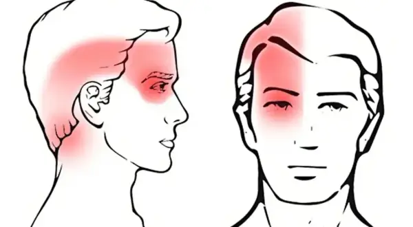 Illustrations de têtes montrant des zones rouges de douleur, suggérant des maux de tête cervicaux.