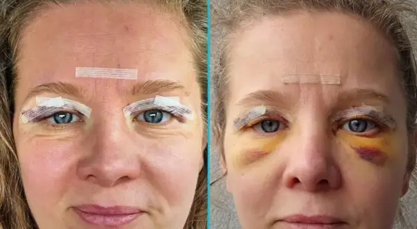 Przed i po zabiegu blefaroplastyki NFZ. Widoczne opuchlizny i siniaki wokół oczu po operacji.