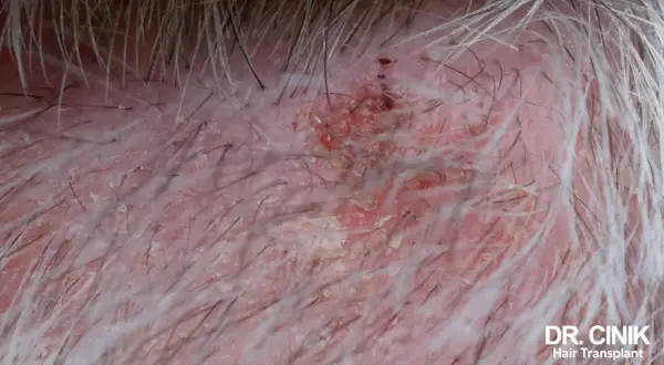 Gros plan sur un cuir chevelu sec et irrité, avec des squames et des rougeurs, suggérant une perte de cheveux.