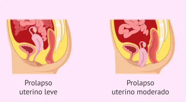 Ilustración comparativa de prolapso uterino leve y moderado, mostrando la posición del útero y órganos pélvicos.