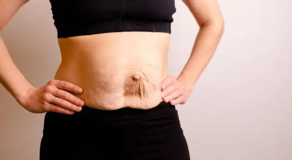 Addome con diastasi addominale di 4 cm, pelle rilassata e smagliature.