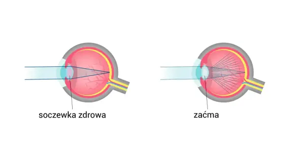 Schemat oka z soczewką zdrową i zaćmą. Promienie światła skupiają się inaczej, wpływając na widzenie. Spojówka jest częścią oka.
