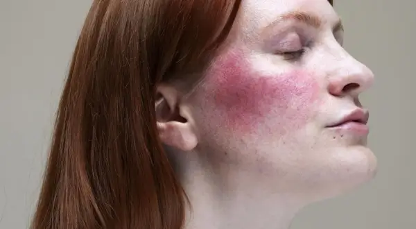 Rötliche Wangen bei Rosacea, ausgelöst durch Alkohol.