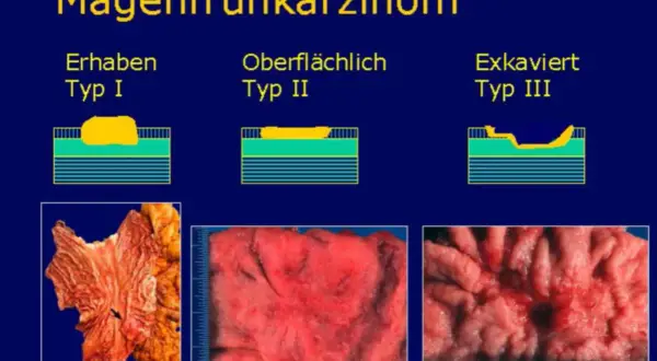 Magenkarzinom-Typen: Erhaben (Typ I), Oberflächlich (Typ II) und Exkaviert (Typ III). Bilder zeigen verschiedene Stadien eines pt2 tumor.