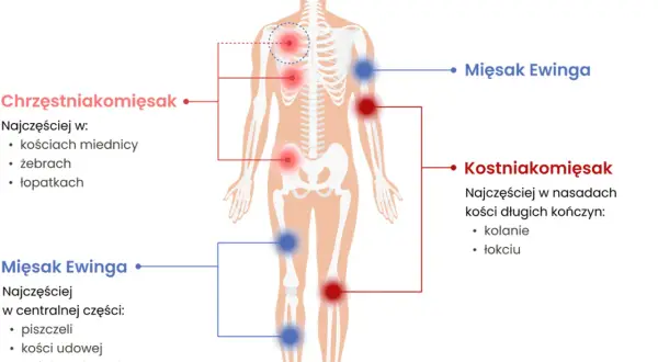 Schemat pokazuje lokalizację mięsaków kości: chrzęstniakomięsaka (czerwone punkty) w miednicy, żebrach, łopatkach; kostniakomięsaka (czerwone punkty) w nasadach kości długich; mięsaka Ewinga (niebieskie punkty) w piszczeli, kościach udowej i ramiennej.