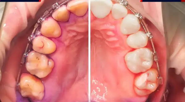 Prima e dopo: la differenza tra placca e tartaro è evidente. I denti appaiono più puliti e sani dopo il trattamento.