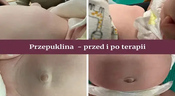 Objawy przepukliny pępkowej: Jak rozpoznać i kiedy działać?