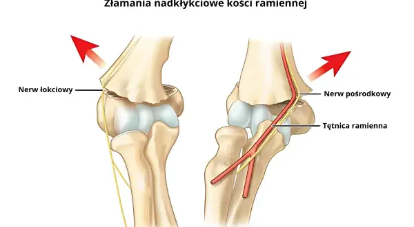 Złamanie nadkłykciowe kości ramiennej. Zobacz, jak zbity łokieć objawy mogą wpływać na nerw łokciowy i naczynia.