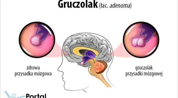 Gruczolak przysadki: objawy psychiczne. Czy to hormony?