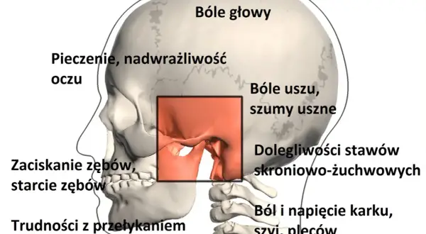 Bruksizm szczeka, powodując bóle głowy, uszu, problemy ze stawami skroniowo-żuchwowymi, pieczenie oczu, zaciskanie i starcie zębów, trudności z przełykaniem oraz ból karku, szyi i pleców.