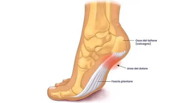 Illustrazione anatomica del piede che mostra l'osso del tallone, la fascia plantare e l'area del dolore, tipica del camminare con la tallonite.