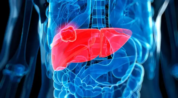 Abbildung einer menschlichen Leber mit einem roten Tumor. Die Darstellung zeigt, wohin Leberkrebs streut, indem sie die Ausbreitung im Körper visualisiert.