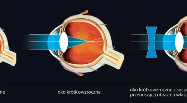 Krótkowzroczność: Jakie soczewki wybrać? Poradnik dla Ciebie