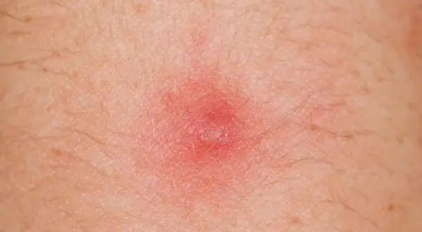 Czerwona, zapalna krostka na skórze, która może wymagać leczenia detreomycyną.